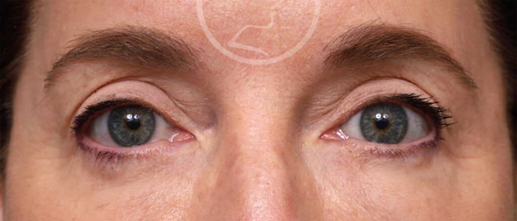 Plastic Surgery Before and After Pictures in Jacksonville, FL - Garcia Facial Plastic Surgery