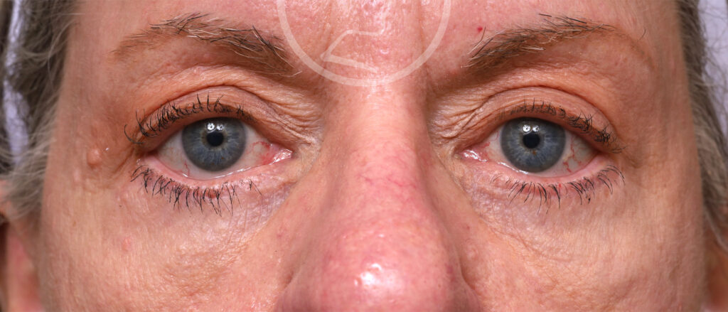 Plastic Surgery Before and After Pictures in Jacksonville, FL - Garcia Facial Plastic Surgery