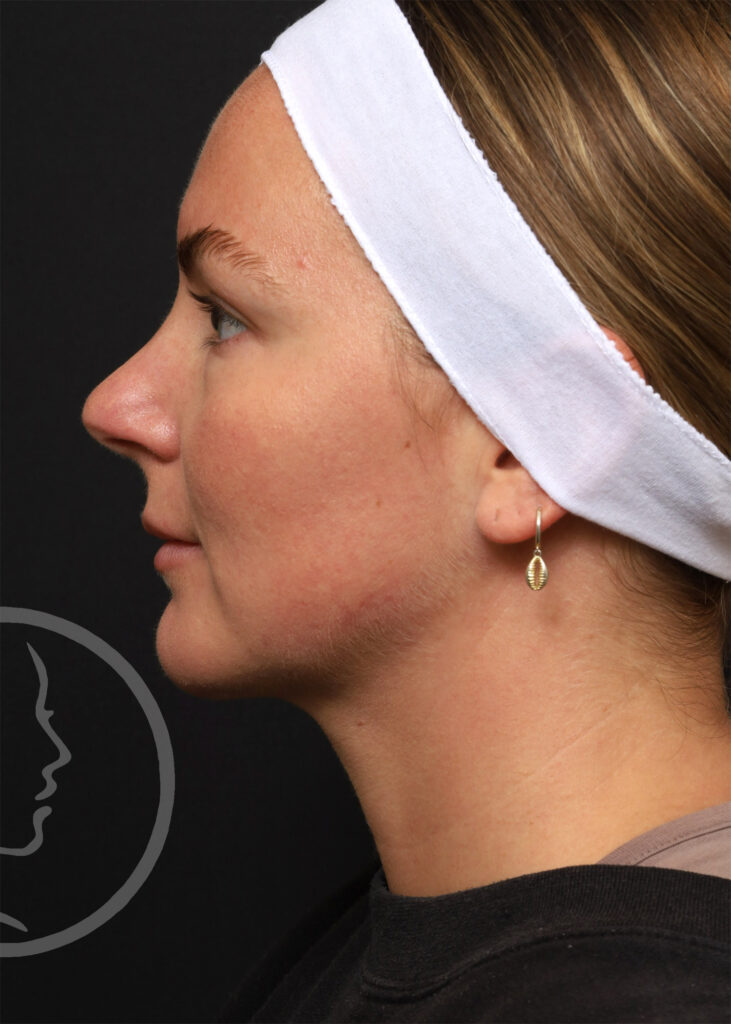 Plastic Surgery Before and After Pictures in Jacksonville, FL - Garcia Facial Plastic Surgery