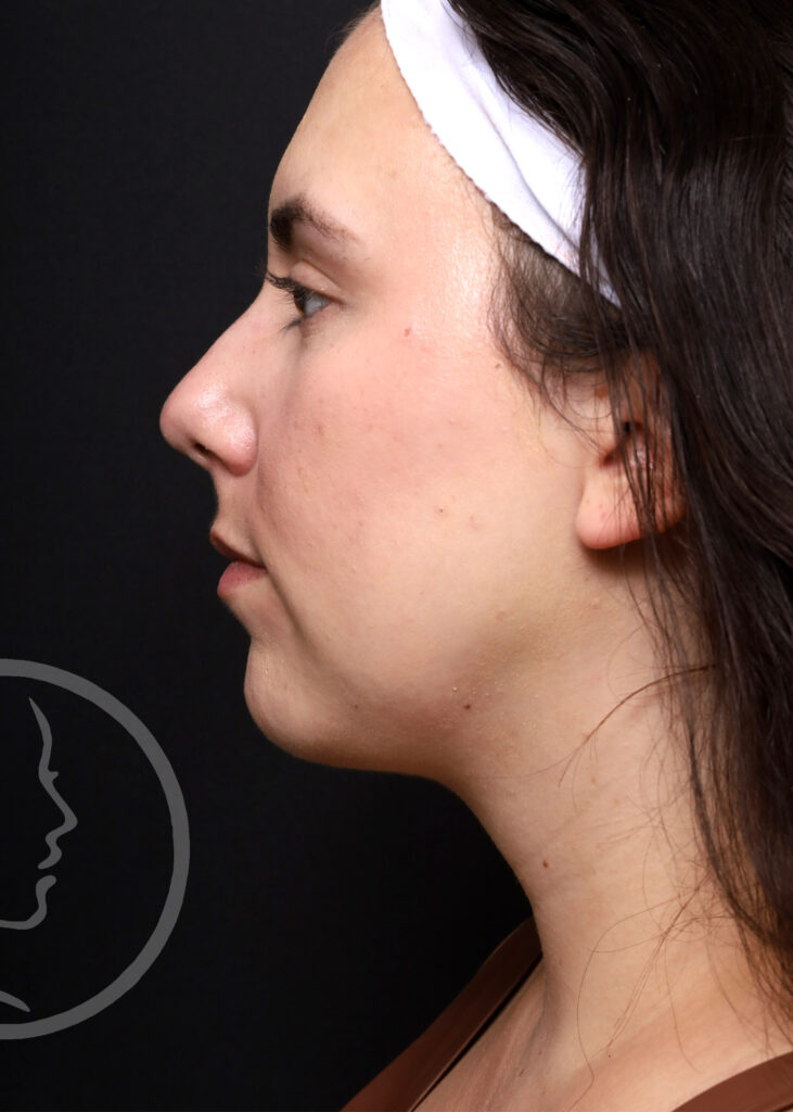 Plastic Surgery Before and After Pictures in Jacksonville, FL - Garcia Facial Plastic Surgery