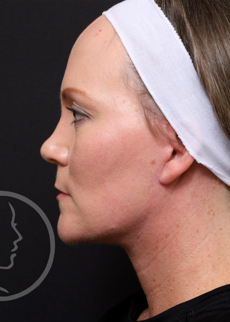 Plastic Surgery Before and After Pictures in Jacksonville, FL - Garcia Facial Plastic Surgery