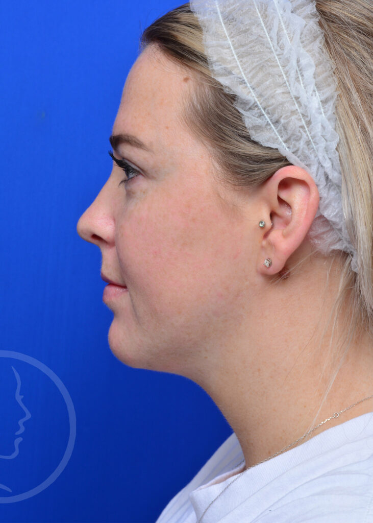 Plastic Surgery Before and After Pictures in Jacksonville, FL - Garcia Facial Plastic Surgery