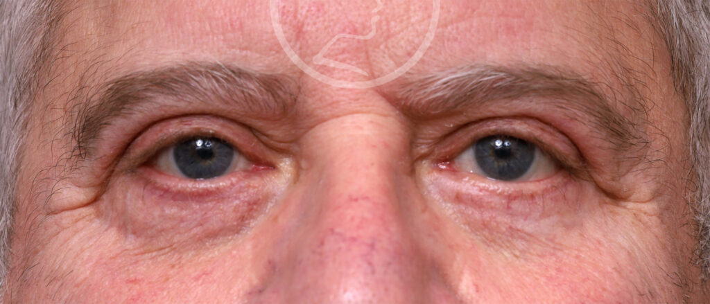 Plastic Surgery Before and After Pictures in Jacksonville, FL - Garcia Facial Plastic Surgery