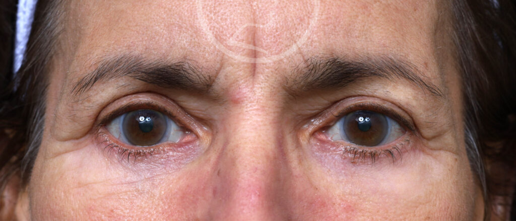 Plastic Surgery Before and After Pictures in Jacksonville, FL - Garcia Facial Plastic Surgery