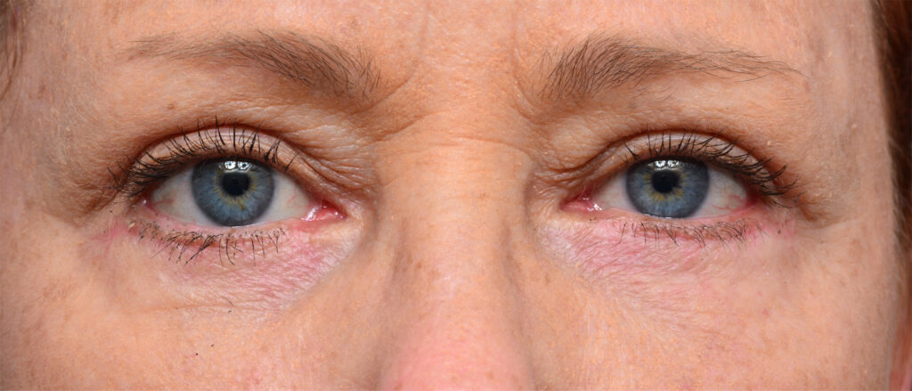 Plastic Surgery Before and After Pictures in Jacksonville, FL - Garcia Facial Plastic Surgery