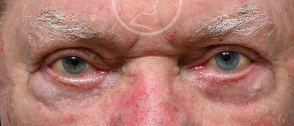 Plastic Surgery Before and After Pictures in Jacksonville, FL - Garcia Facial Plastic Surgery