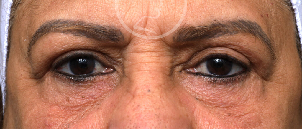 Plastic Surgery Before and After Pictures in Jacksonville, FL - Garcia Facial Plastic Surgery
