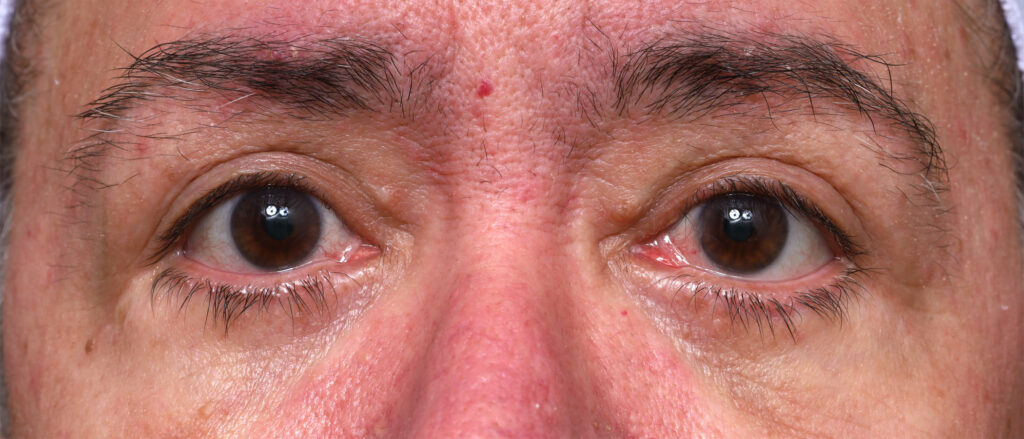 Plastic Surgery Before and After Pictures in Jacksonville, FL - Garcia Facial Plastic Surgery