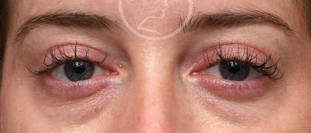 Plastic Surgery Before and After Pictures in Jacksonville, FL - Garcia Facial Plastic Surgery