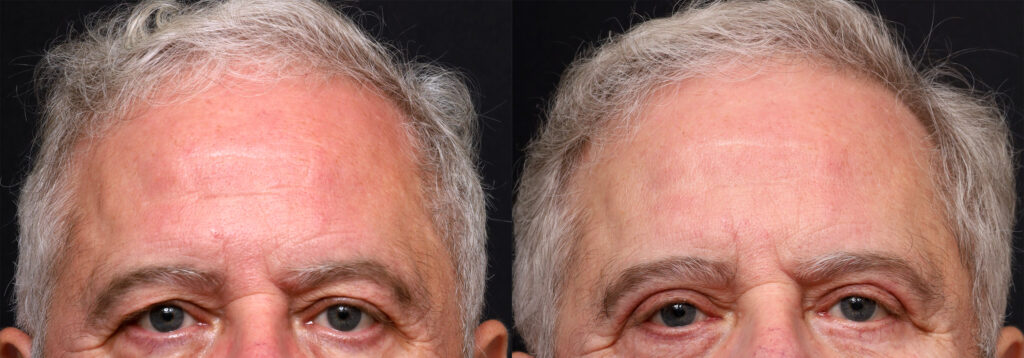 Plastic Surgery Before and After Pictures in Jacksonville, FL - Garcia Facial Plastic Surgery
