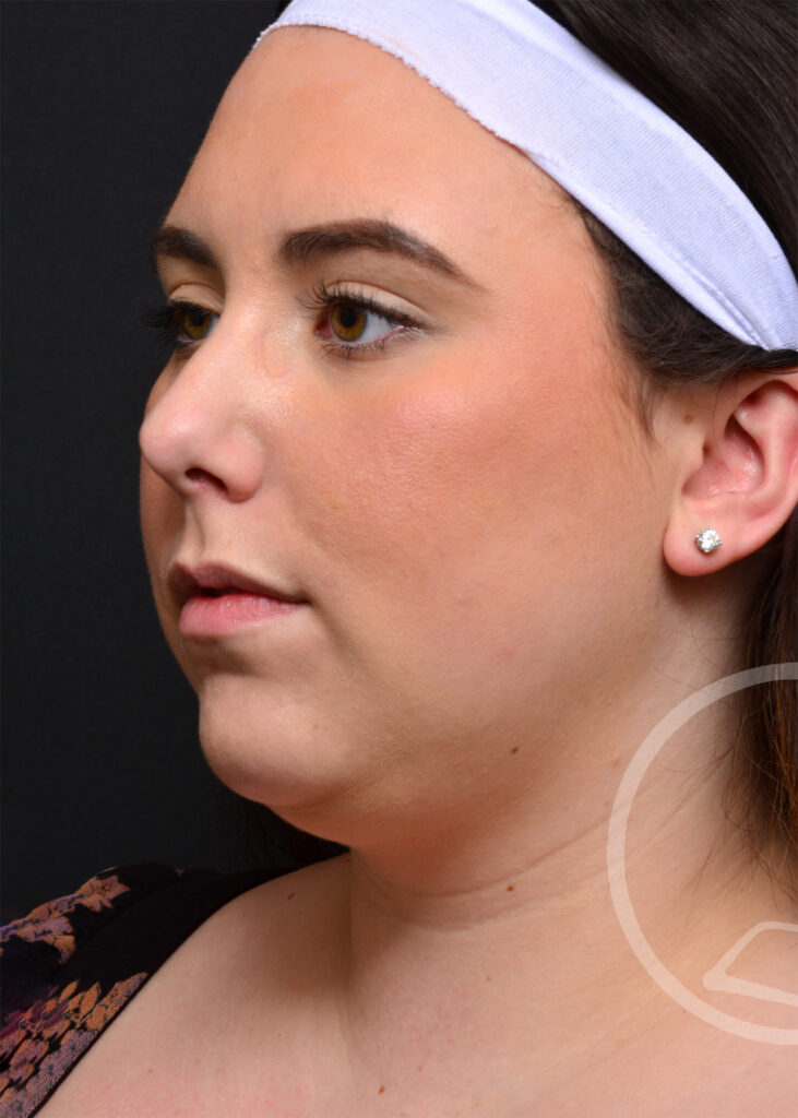 Plastic Surgery Before and After Pictures in Jacksonville, FL - Garcia Facial Plastic Surgery