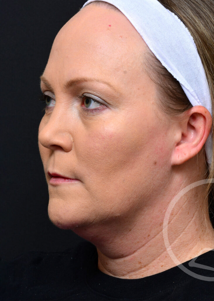 Plastic Surgery Before and After Pictures in Jacksonville, FL - Garcia Facial Plastic Surgery