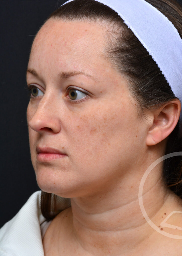 Plastic Surgery Before and After Pictures in Jacksonville, FL - Garcia Facial Plastic Surgery