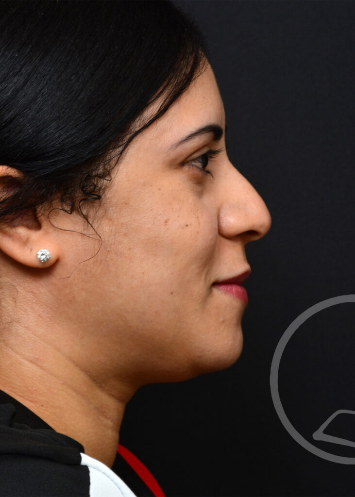 Plastic Surgery Before and After Pictures in Jacksonville, FL - Garcia Facial Plastic Surgery