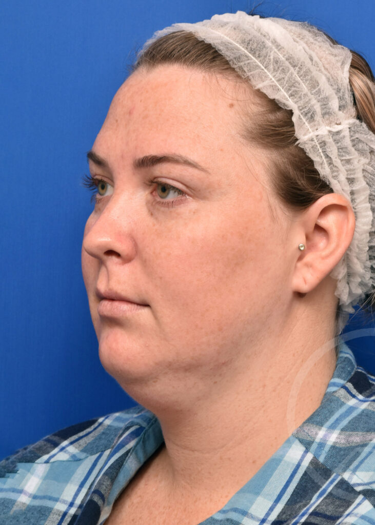 Plastic Surgery Before and After Pictures in Jacksonville, FL - Garcia Facial Plastic Surgery