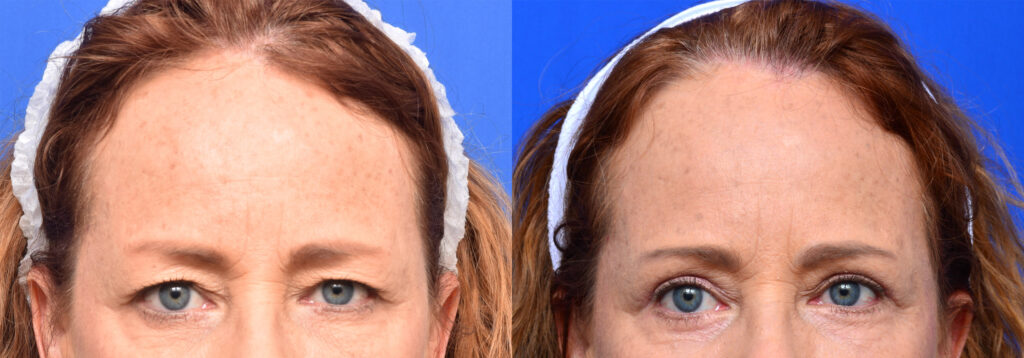 Plastic Surgery Before and After Pictures in Jacksonville, FL - Garcia Facial Plastic Surgery