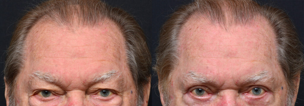 Plastic Surgery Before and After Pictures in Jacksonville, FL - Garcia Facial Plastic Surgery