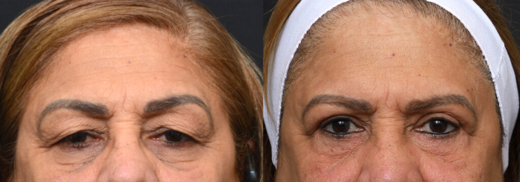 Plastic Surgery Before and After Pictures in Jacksonville, FL - Garcia Facial Plastic Surgery