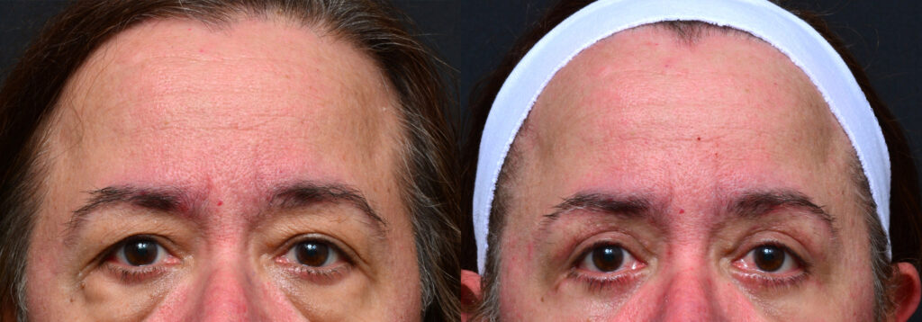 Plastic Surgery Before and After Pictures in Jacksonville, FL - Garcia Facial Plastic Surgery