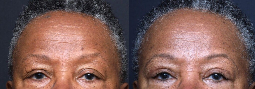 Plastic Surgery Before and After Pictures in Jacksonville, FL - Garcia Facial Plastic Surgery