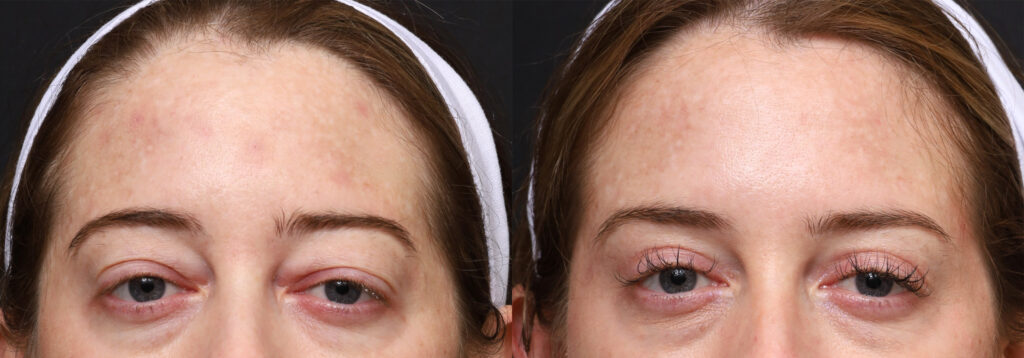 Plastic Surgery Before and After Pictures in Jacksonville, FL - Garcia Facial Plastic Surgery