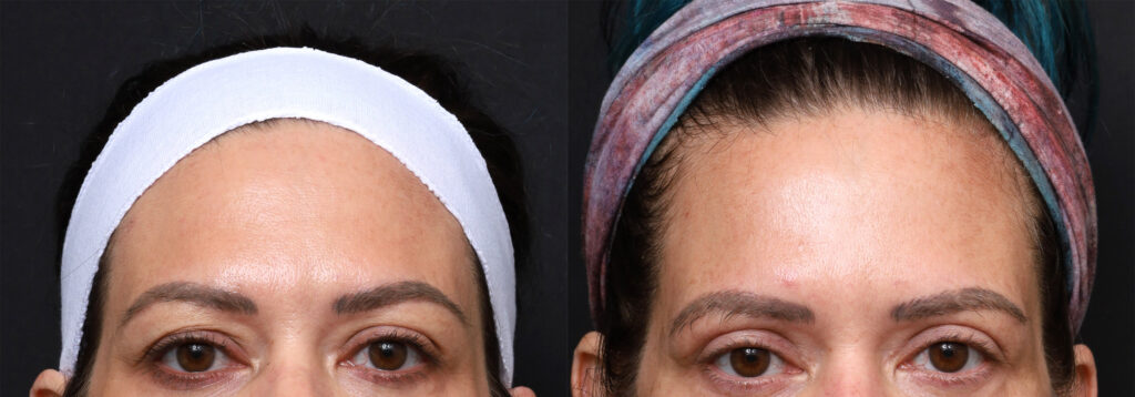 Plastic Surgery Before and After Pictures in Jacksonville, FL - Garcia Facial Plastic Surgery