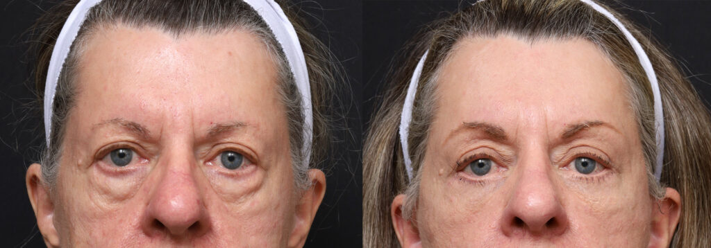 Plastic Surgery Before and After Pictures in Jacksonville, FL - Garcia Facial Plastic Surgery