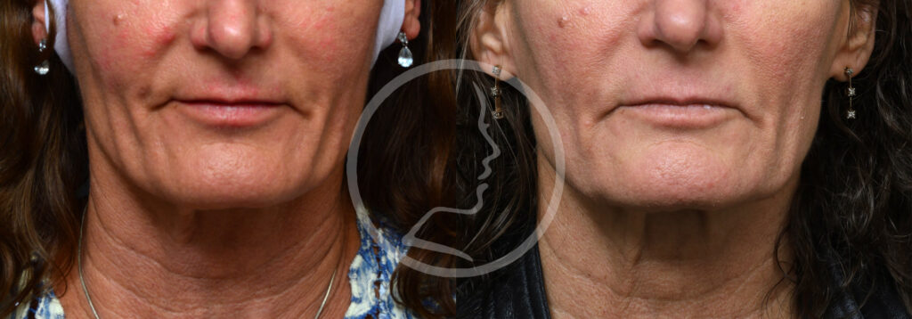 Plastic Surgery Before and After Pictures in Jacksonville, FL - Garcia Facial Plastic Surgery