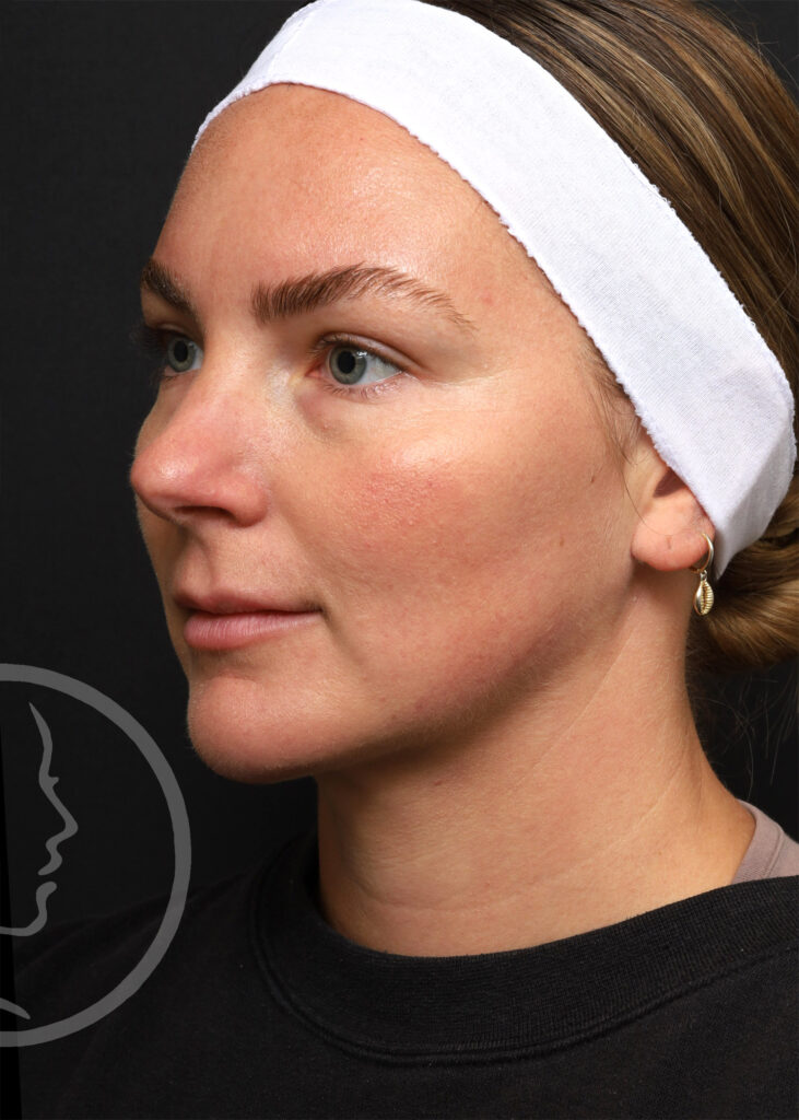 Plastic Surgery Before and After Pictures in Jacksonville, FL - Garcia Facial Plastic Surgery