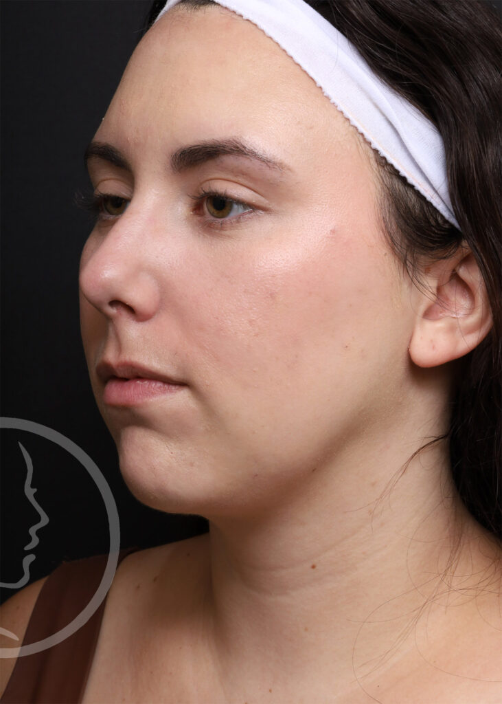 Plastic Surgery Before and After Pictures in Jacksonville, FL - Garcia Facial Plastic Surgery