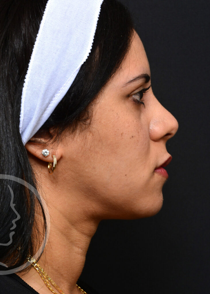 Plastic Surgery Before and After Pictures in Jacksonville, FL - Garcia Facial Plastic Surgery
