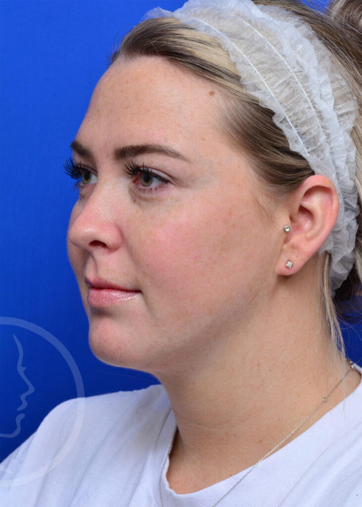 Plastic Surgery Before and After Pictures in Jacksonville, FL - Garcia Facial Plastic Surgery
