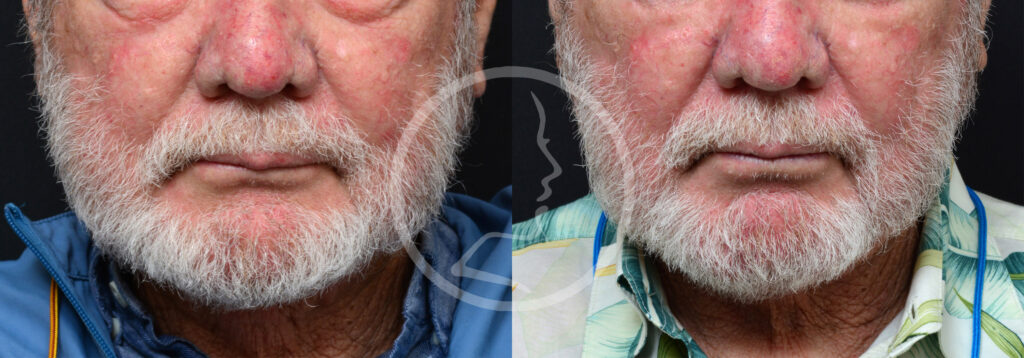 Plastic Surgery Before and After Pictures in Jacksonville, FL - Garcia Facial Plastic Surgery