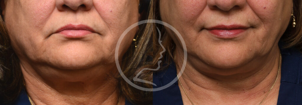 Plastic Surgery Before and After Pictures in Jacksonville, FL - Garcia Facial Plastic Surgery