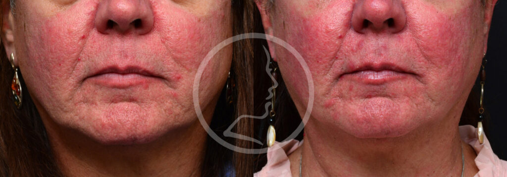 Plastic Surgery Before and After Pictures in Jacksonville, FL - Garcia Facial Plastic Surgery