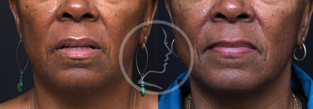 Plastic Surgery Before and After Pictures in Jacksonville, FL - Garcia Facial Plastic Surgery