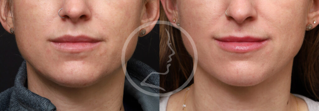 Plastic Surgery Before and After Pictures in Jacksonville, FL - Garcia Facial Plastic Surgery