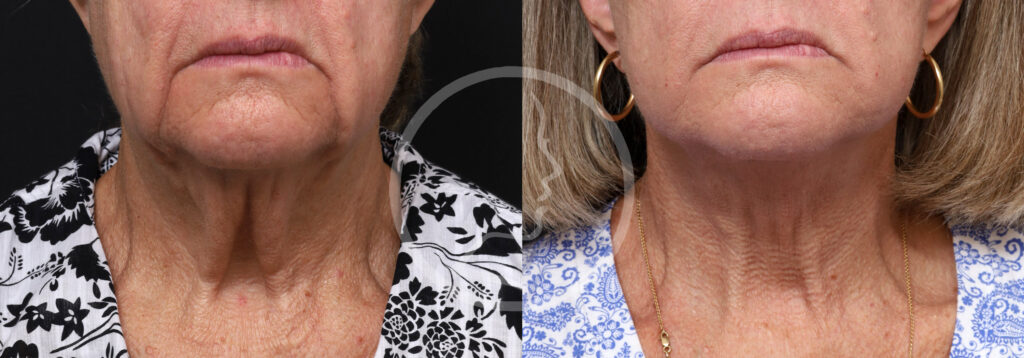 Plastic Surgery Before and After Pictures in Jacksonville, FL - Garcia Facial Plastic Surgery