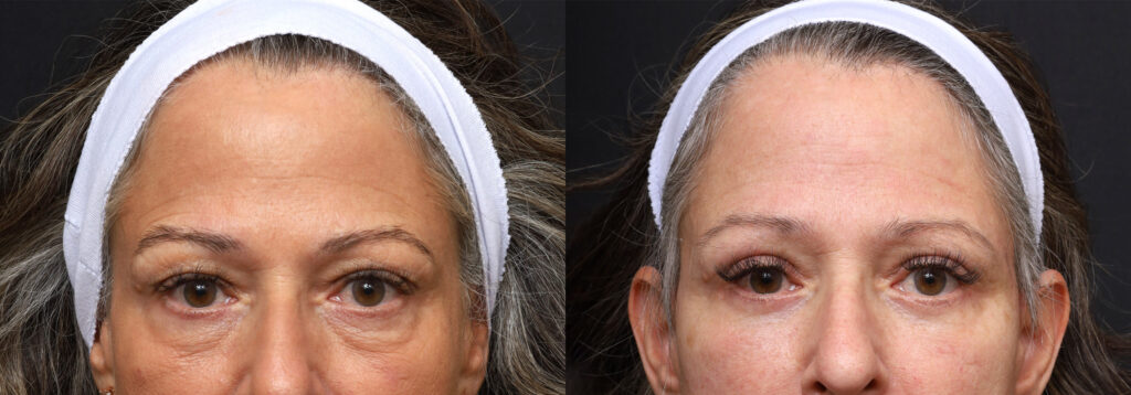 Plastic Surgery Before and After Pictures in Jacksonville, FL - Garcia Facial Plastic Surgery