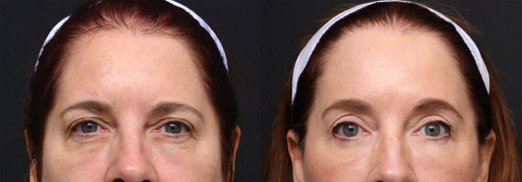 Plastic Surgery Before and After Pictures in Jacksonville, FL - Garcia Facial Plastic Surgery