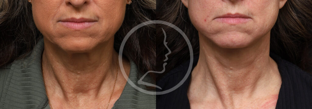 Plastic Surgery Before and After Pictures in Jacksonville, FL - Garcia Facial Plastic Surgery