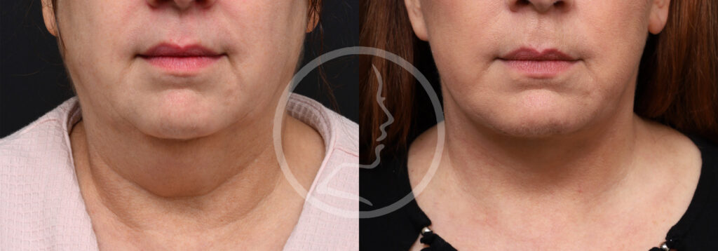 Plastic Surgery Before and After Pictures in Jacksonville, FL - Garcia Facial Plastic Surgery