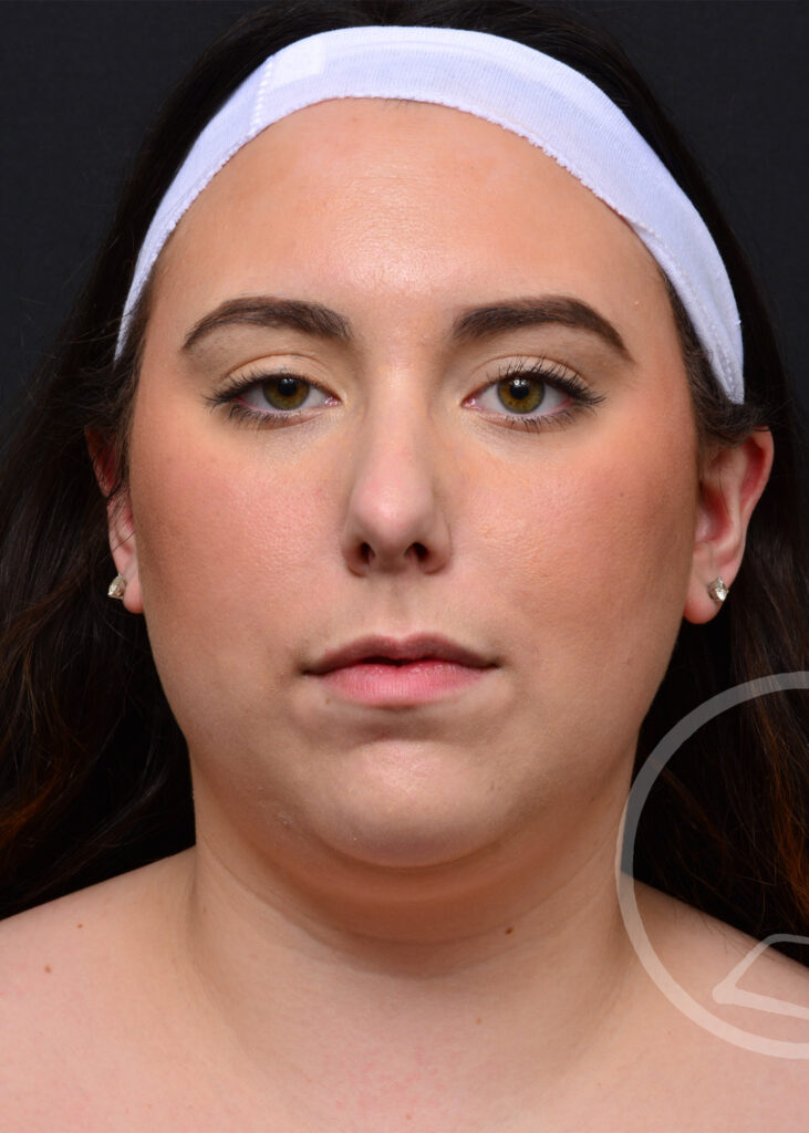 Plastic Surgery Before and After Pictures in Jacksonville, FL - Garcia Facial Plastic Surgery