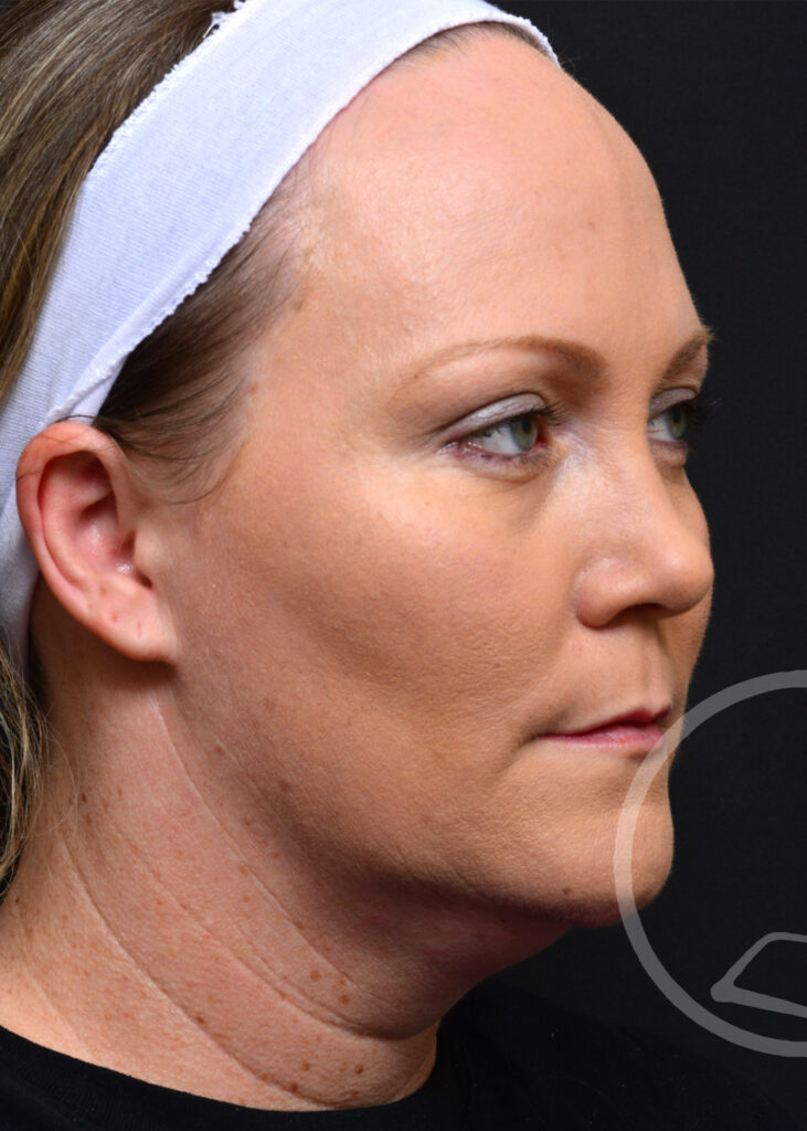 Plastic Surgery Before and After Pictures in Jacksonville, FL - Garcia Facial Plastic Surgery