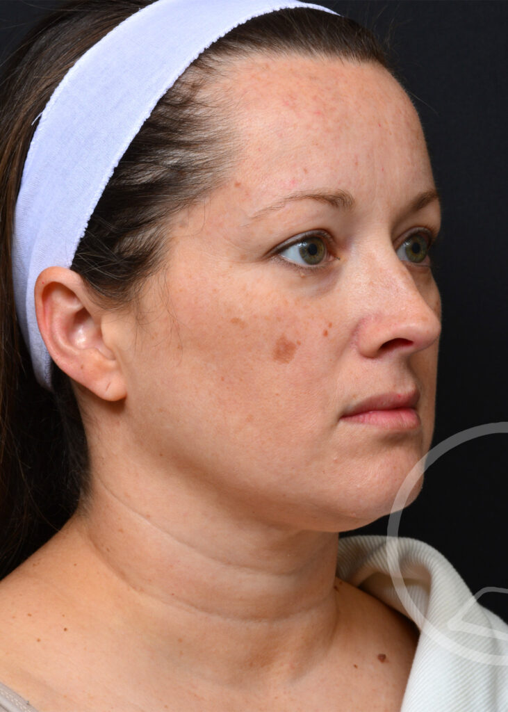 Plastic Surgery Before and After Pictures in Jacksonville, FL - Garcia Facial Plastic Surgery