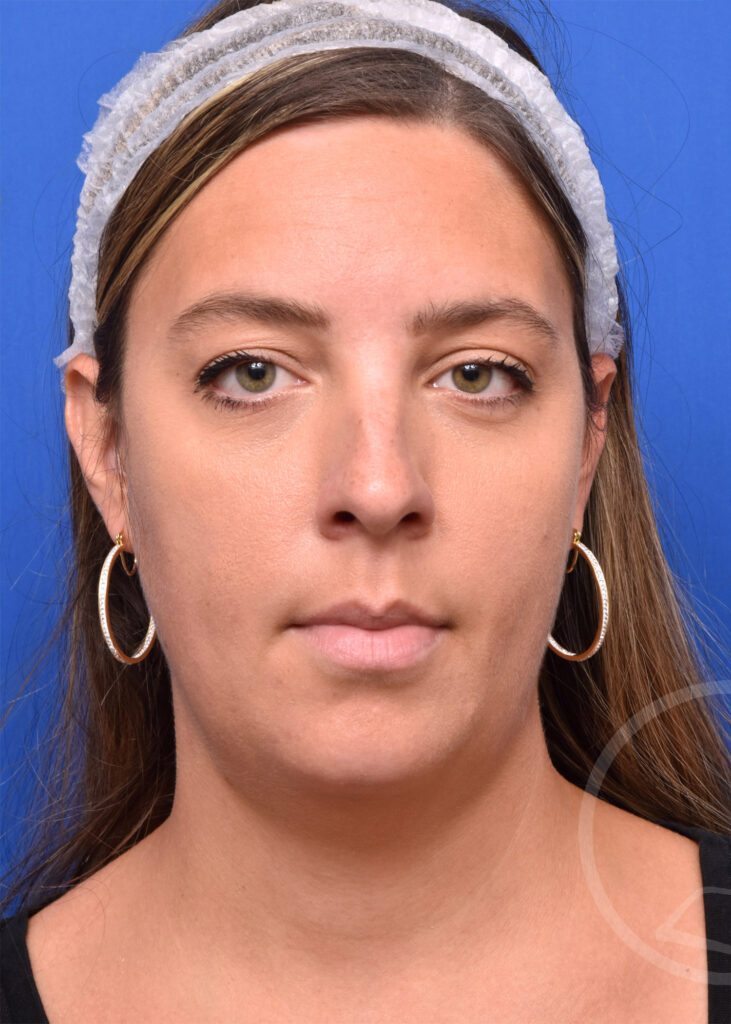 Plastic Surgery Before and After Pictures in Jacksonville, FL - Garcia Facial Plastic Surgery