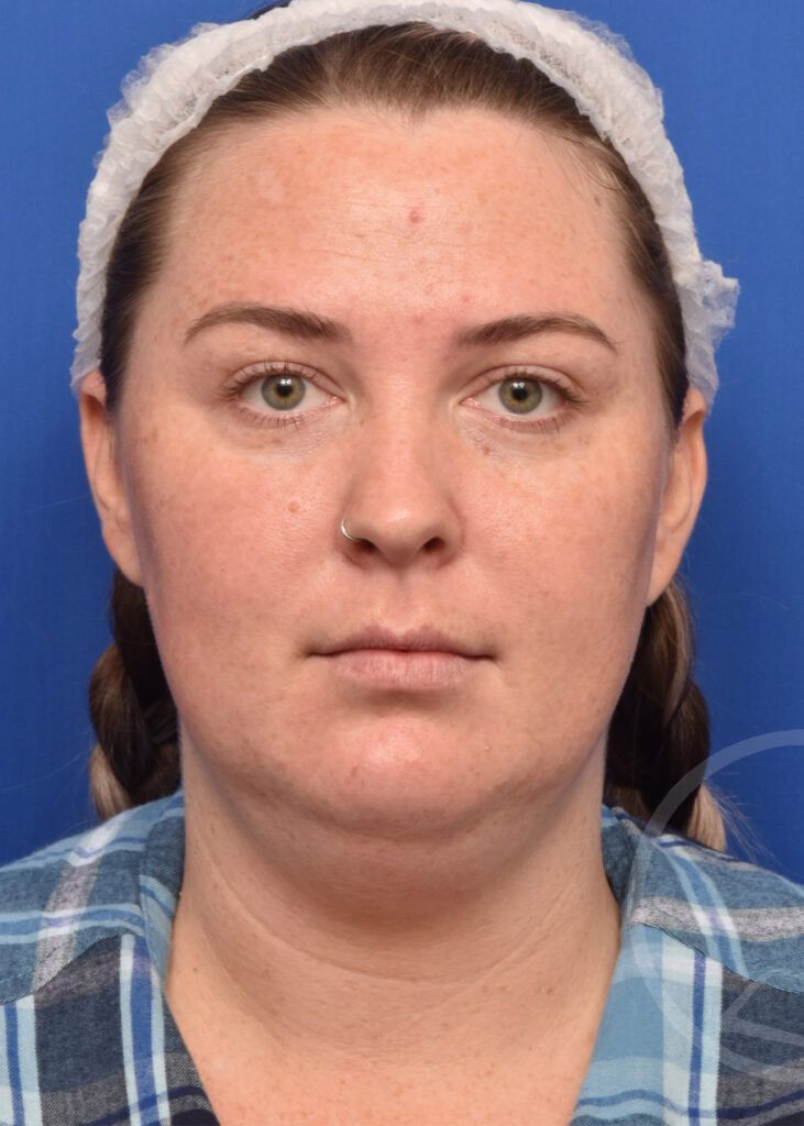Plastic Surgery Before and After Pictures in Jacksonville, FL - Garcia Facial Plastic Surgery