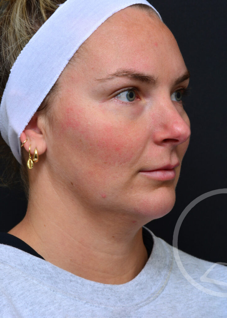 Plastic Surgery Before and After Pictures in Jacksonville, FL - Garcia Facial Plastic Surgery