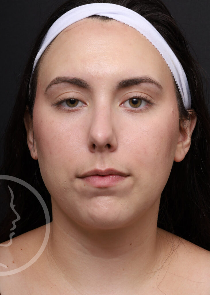 Plastic Surgery Before and After Pictures in Jacksonville, FL - Garcia Facial Plastic Surgery