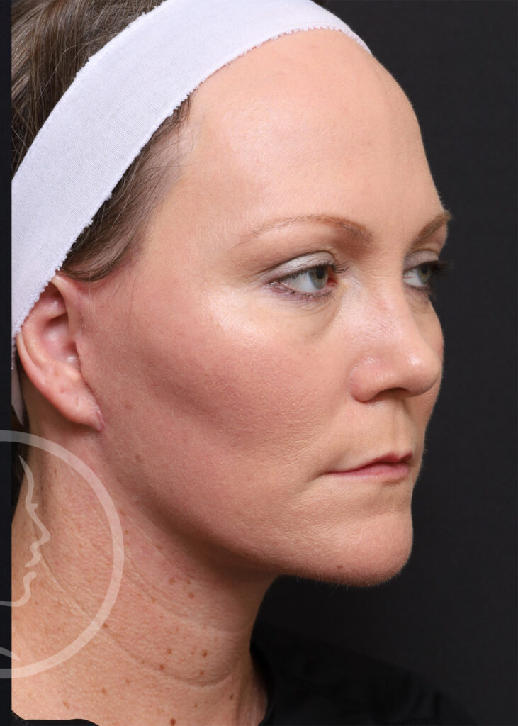 Plastic Surgery Before and After Pictures in Jacksonville, FL - Garcia Facial Plastic Surgery